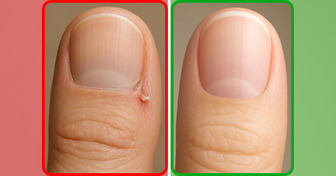 5 Serious Health Problems Your Nails Could Be Trying to Warn You About