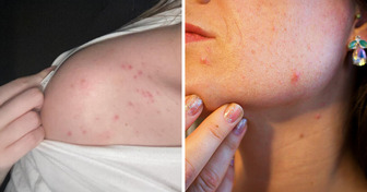 Why Acne Appears on These 8 Body Areas, and What You Should Do