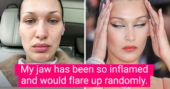 “I Feel So Bad for My Body,” Bella Hadid Gives Us a Rare Look at the Disease That Changed Her Face