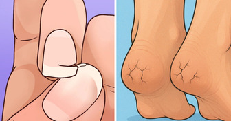 12 Unexpected Signs You Might Be Intolerant to Dairy