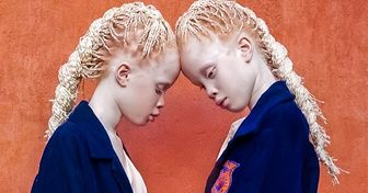 A Year Ago Unusual Twins Amazed the Internet, Look at Them Now