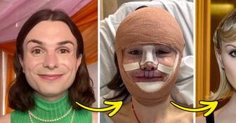 Dylan Mulvaney, Transgender and Activist, Reveals Crazy Results of Her Facial Surgery