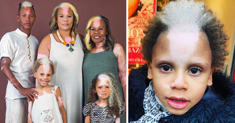 Meet Little Samuel, a Boy With a Rare Genetic Skin Condition Who Became a Supermodel
