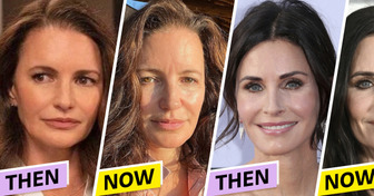 5 Celebrities Who Removed Their Facial Fillers and Loved the Results