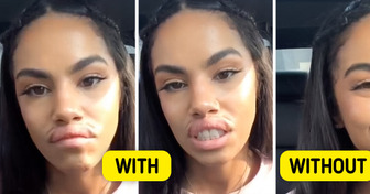 A Woman Pranks Her Partner With Lip Fillers and His Epic Response Steals the Spotlight