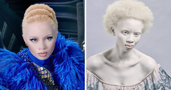 “Different” Doesn’t Mean “Deficient”, How a Model With Albinism Knocks Down False Beauty Stereotypes