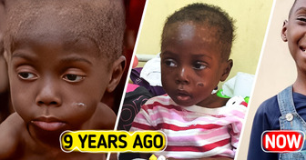 “His Life Was Ending,” a Woman Rescued a Starving, Ill Boy; Look at Him 9 Years Later