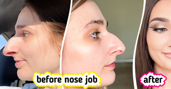 Woman Spent a Decade Saving for a Nose Job — The Results Leave the Internet Divided