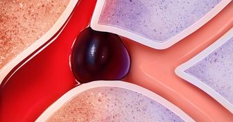 8 Effective Ways to Prevent Strokes, Get Rid of Headaches and Fatigue