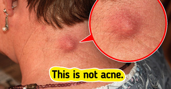 7 Skin Bumps That Aren’t Acne You Might Be Overlooking
