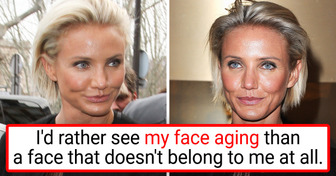 8 Celebrities Who Tried Cosmetic Surgery Once and Said “Never Again”