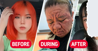 “Are You Allergic to Your Baby?” Woman Shares How Pregnancy Changed Her Face That Proves the Power of Self-Love and Compassion