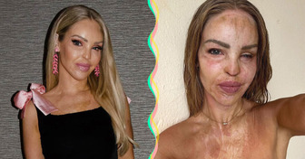 “I’ve Reached the End of the Road,” Katie Piper Shares a Bright Update 16 Years After Acid Attack