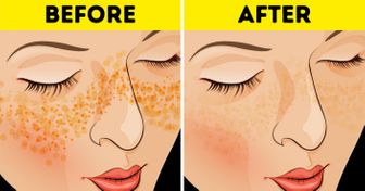 7 Tips From the Old Days to Get Rid of Acne Scars and Skin Imperfections