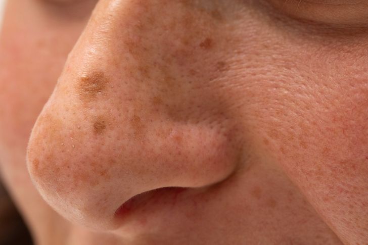 Your Face Moles Reveal About Your Personality 