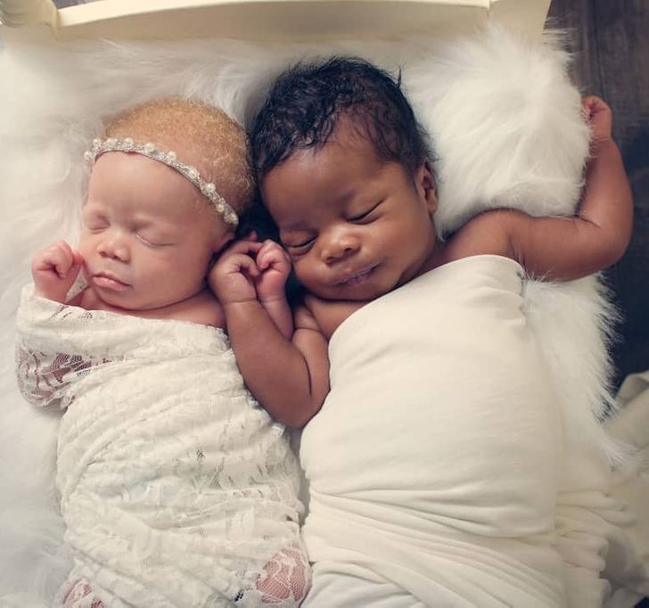 Twins With Different Skin Colors Astonished Their Mom When They Were Born