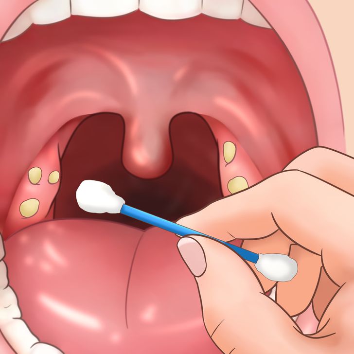 How long does it take tonsil stones to fall out 11 Tips For Removing Tonsil Stones That Ll Make You Sigh With Relief