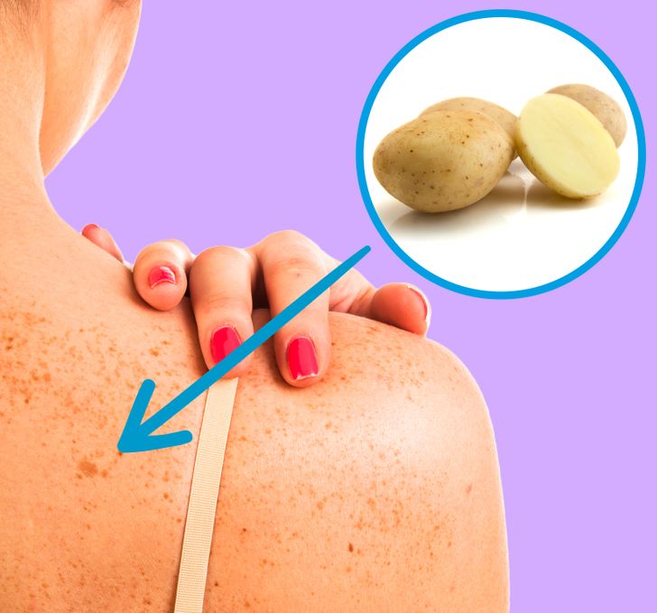 11 طريقة لإزالة البقع الداكنة من بشرتك