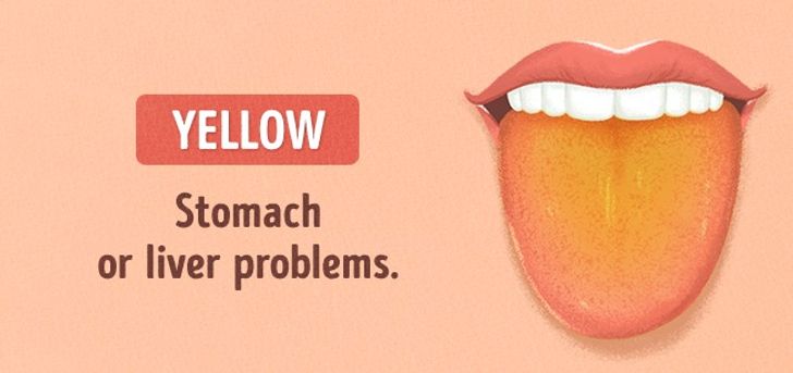 13 Things Your Tongue Is Trying to Tell You About Your Health