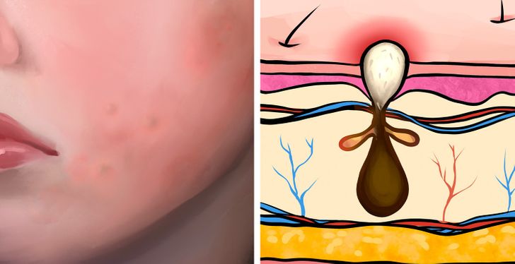 6 Types of Acne and What Might Cause Them