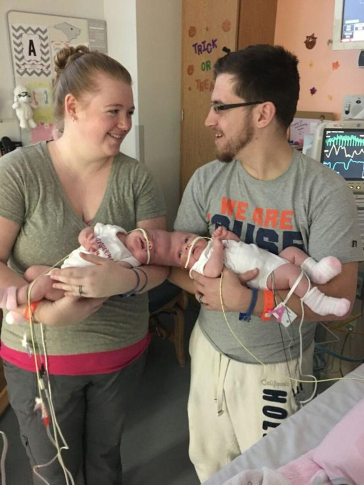 Formerly Conjoined Twins Beat 2% Survival Odds, and Reach Their First Life Goal