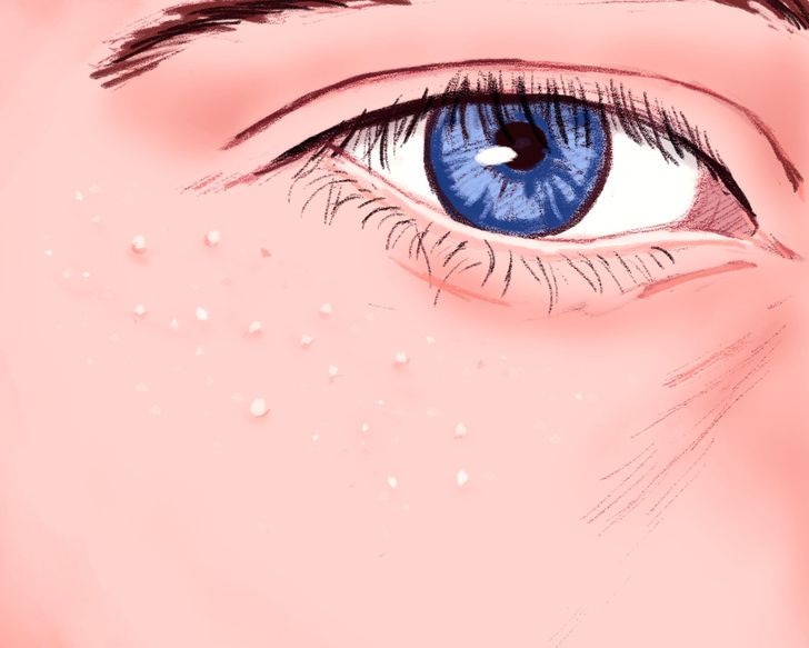 What Are Those White Pimples That Appear Around Your Eyes (Note: Don’t Squeeze Them!)