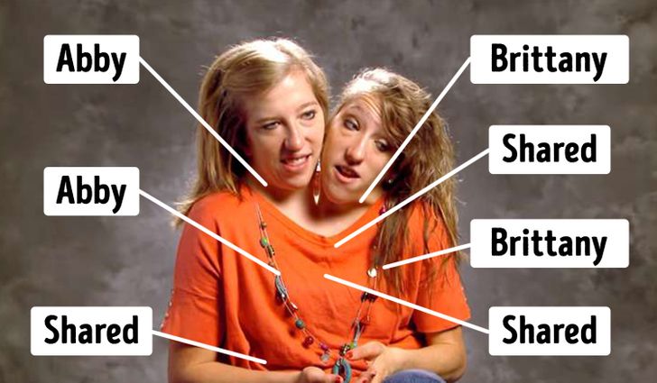 Amazing story of conjoined twins Abigail and Brittany Hensel