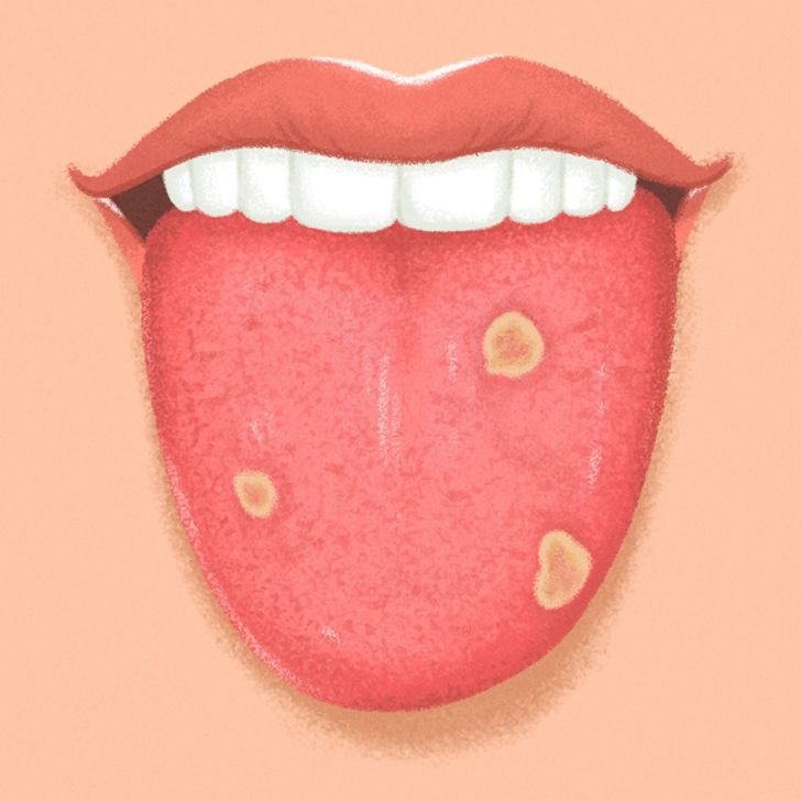 9 Things Your Tongue Is Trying to Tell You About Your Health