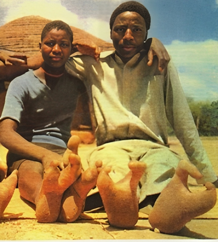 The African Tribe With Ostrich Feet: Why They Only Have Two Toes on Each  Foot / Bright Side