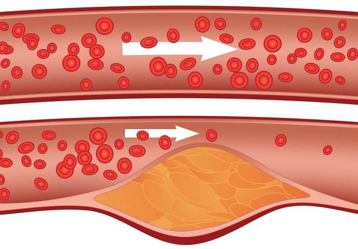 7 Dangerous Signs of Blocked Arteries We Often Ignore