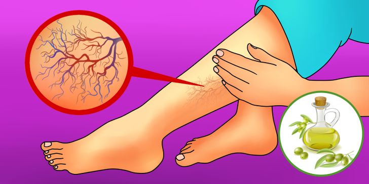 recomandări pentru picioarele varicoase dangle sânge cu varicoză