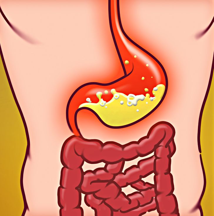 6 Signs You’re Suffering From Acid Reflux and How to Fix It