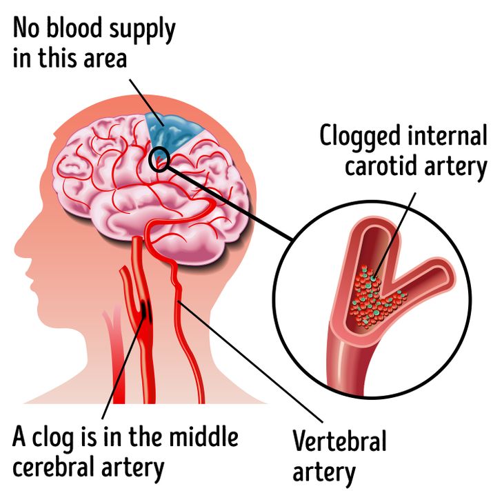 How to Recognize a Stroke and What to Do to Prevent Its Damaging Effects