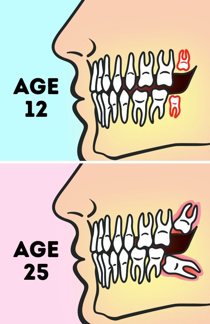 Do We Really Need to Remove Wisdom Teeth?