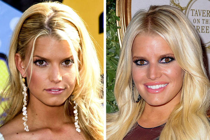 16 Celebrities Who Regretted Their Cosmetic Procedures / Bright Side