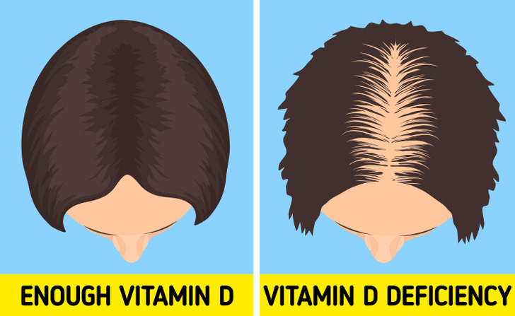 Update 114+ vitamin d deficiency hair loss