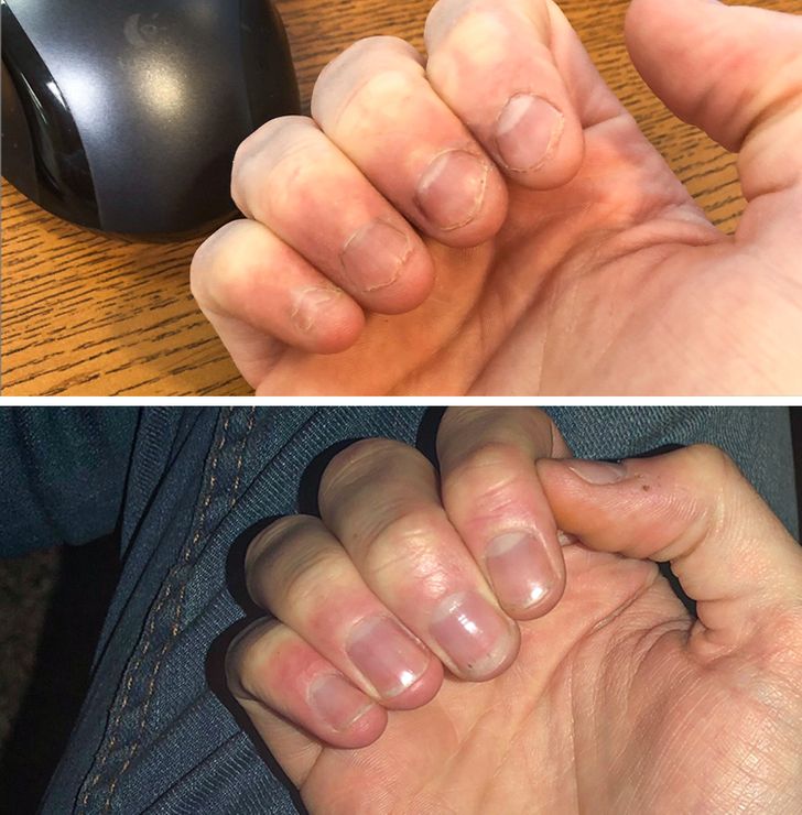 10 Tips to Stop Biting Your Nails Once and for All