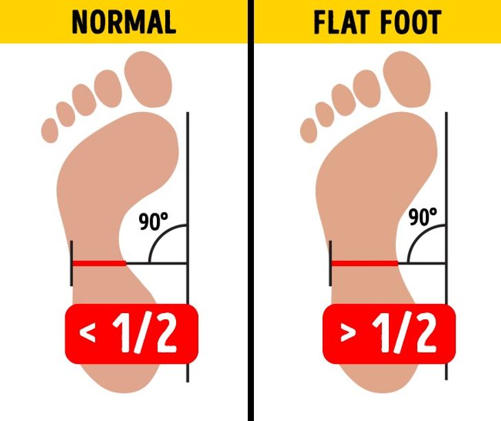 Having Flat Feet Can Destroy Your Knees 