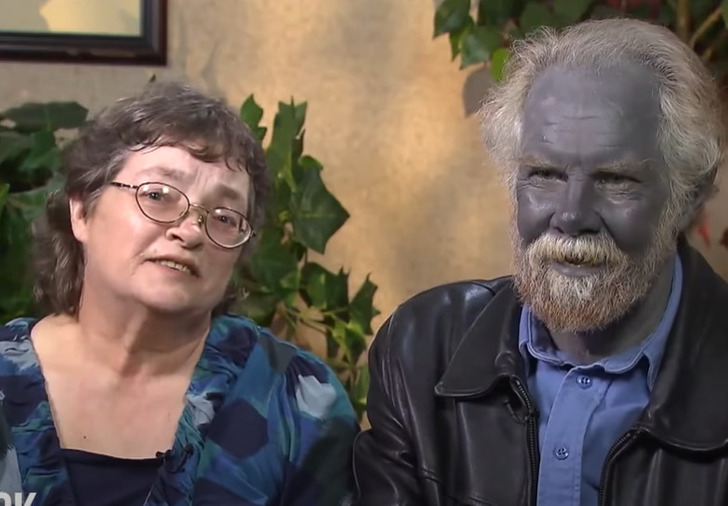 Why this man's skin turned blue