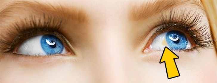 12 Things Your Eyes Can Tell About Your Health