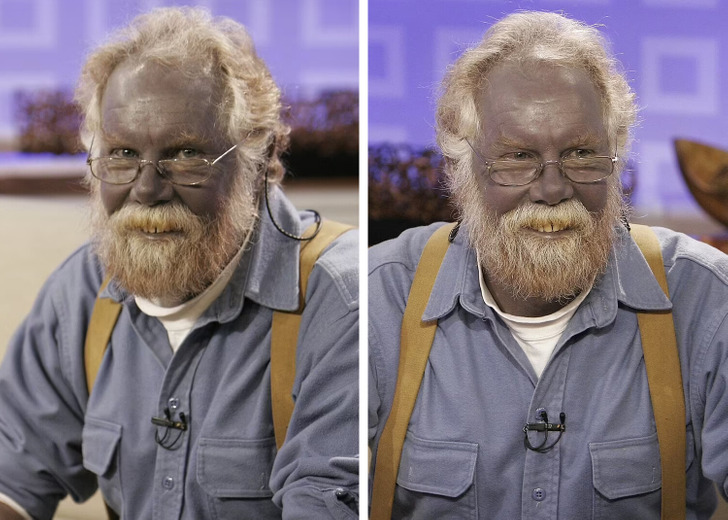 Man turned completely blue after taking dietary supplements for years