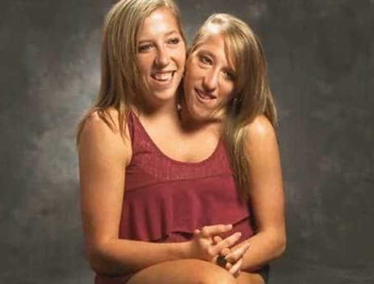 The Twins Who Share A Body: Watch story of Abigail and Brittany Hensel's  life