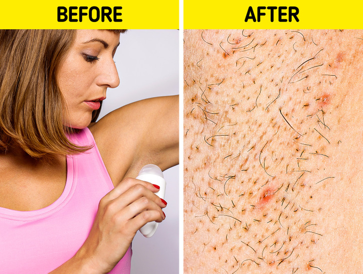 6 Ways to Get Rid of Ingrown Hairs Once and for All