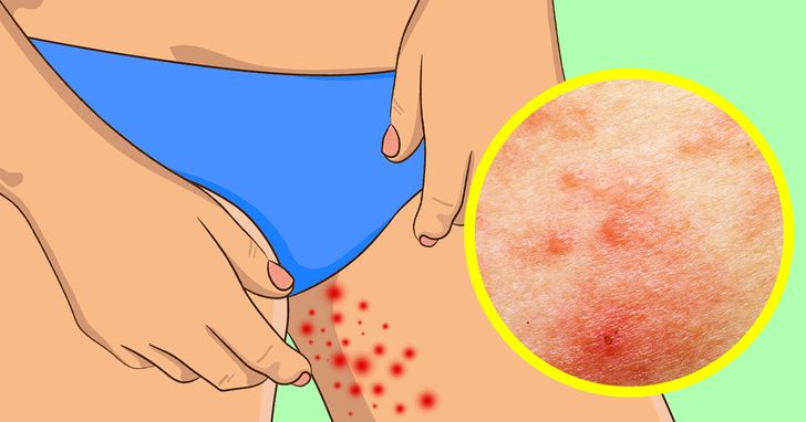 10 Effective Ways To Prevent A Rash On The Inner Thighs