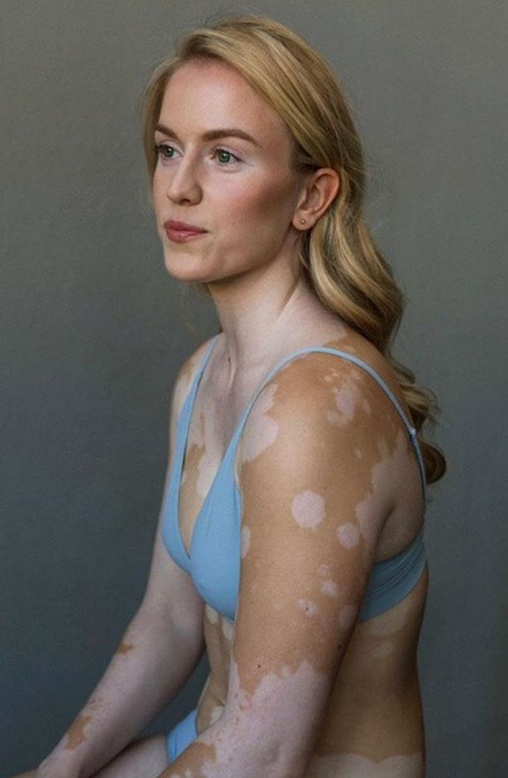 A Photographer With Vitiligo Captures the Beauty of Women With the Same Condition, and It’s a Sight to Behold