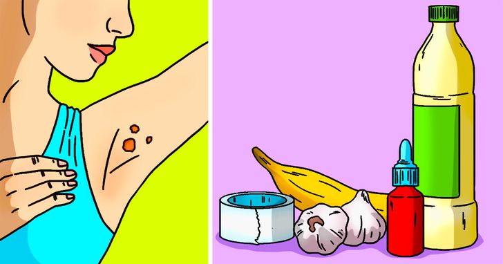 How to Remove Annoying Papillomas and Warts Once For All