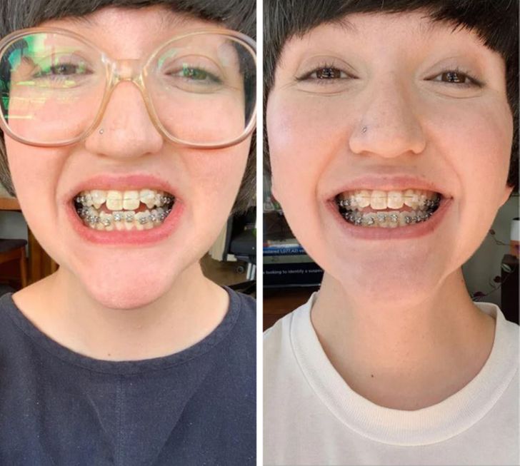 15 ภาพก่อน-หลัง ที่พิสูจน์แล้วว่าการจัดฟันทำให้ใบหน้าของเราเปลี่ยนไป
