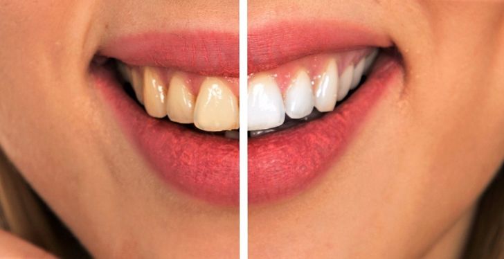 8 Simple Ways To Naturally Reverse Cavities And Heal Tooth Decay