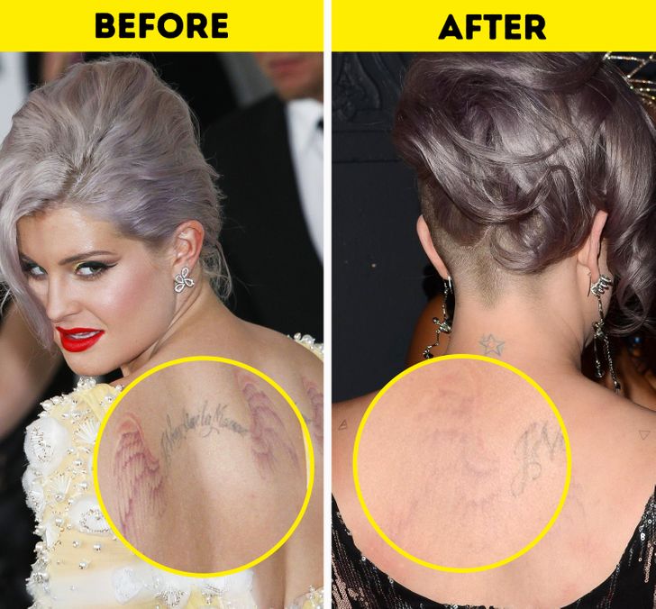 Laser Tattoo Removal | Cutera Enlighten | Melbourne