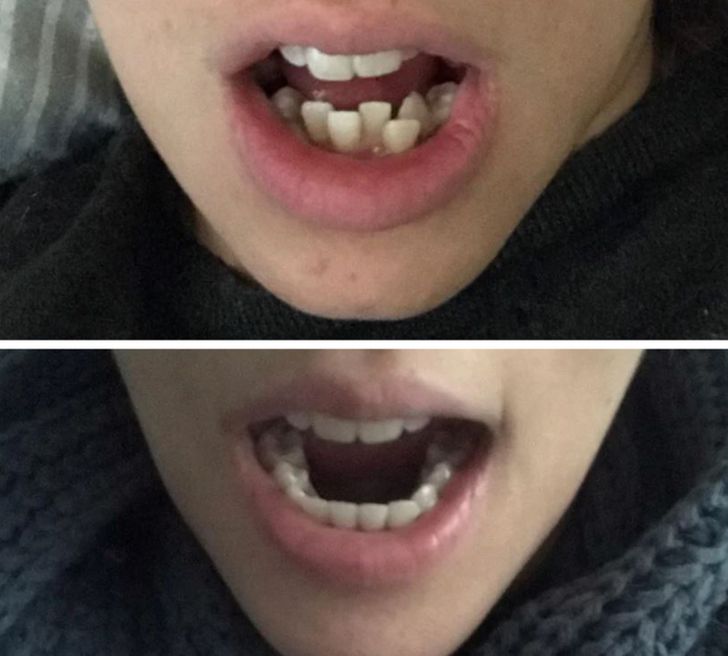 Herkesin Dişlerinin Mükemmel Bir Gülüşe Dönüştürülebileceğini Kanıtlayan 15 Fotoğraf